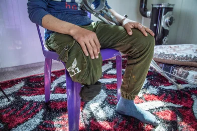Kind uit Gaza met geamputeerd onderbeen Kind uit Gaza met geamputeerd onderbeen